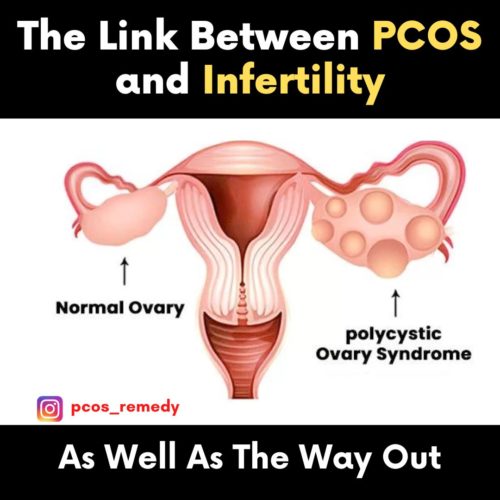 The link between PCOS and infertility and the way out